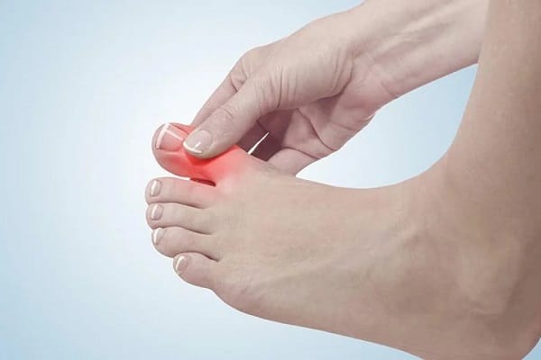 Người bệnh gút có ăn được tôm không? Cần lưu ý gì?