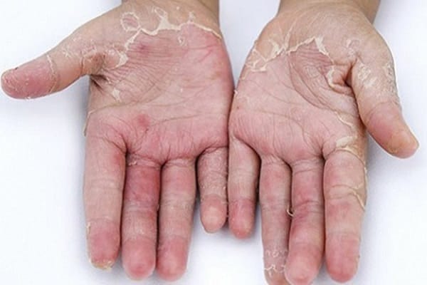Nguyên nhân khác gây bong tróc da tay