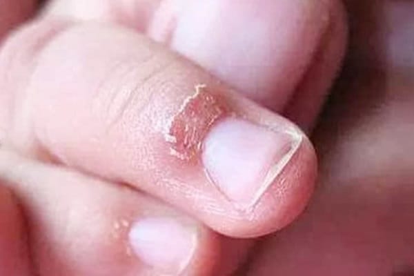 Chuyên gia giải đáp: Tróc da đầu ngón tay thiếu chất gì?