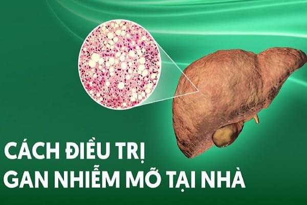 Bật mí 10+ cách trị gan nhiễm mỡ tại nhà hiệu quả nhất