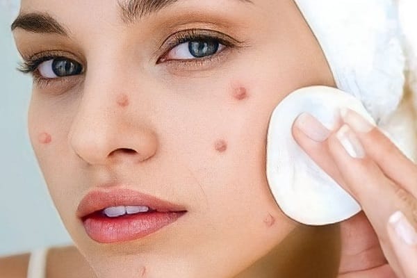 Uống Biotin có nổi mụn không? Uống với liều lượng bao nhiêu?